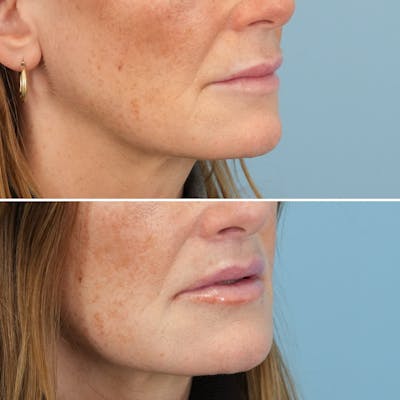 Lip Lift Before & After Gallery - Patient 141568 - Image 4