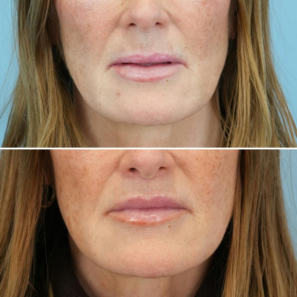 Lip Lift Before & After Gallery - Patient 141568 - Image 2