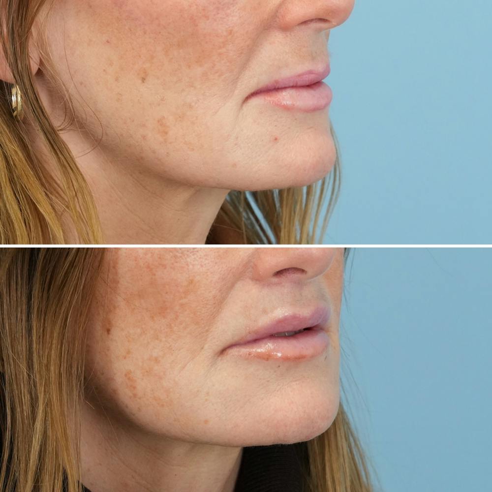 Lip Lift Before & After Gallery - Patient 141568 - Image 5