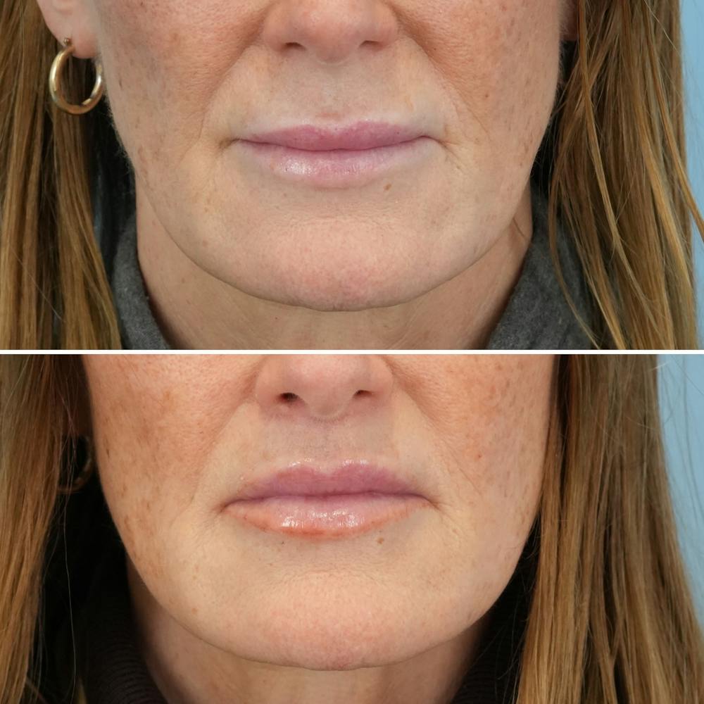 Lip Lift Before & After Gallery - Patient 141568 - Image 1