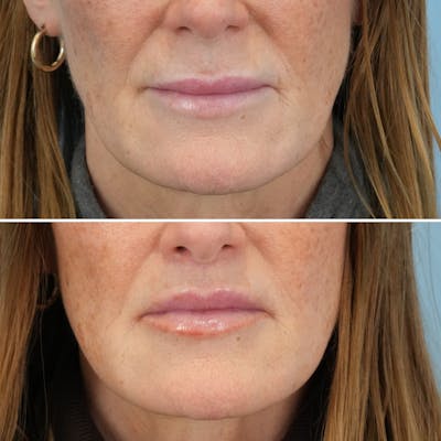 Lip Lift Before & After Gallery - Patient 141568 - Image 1