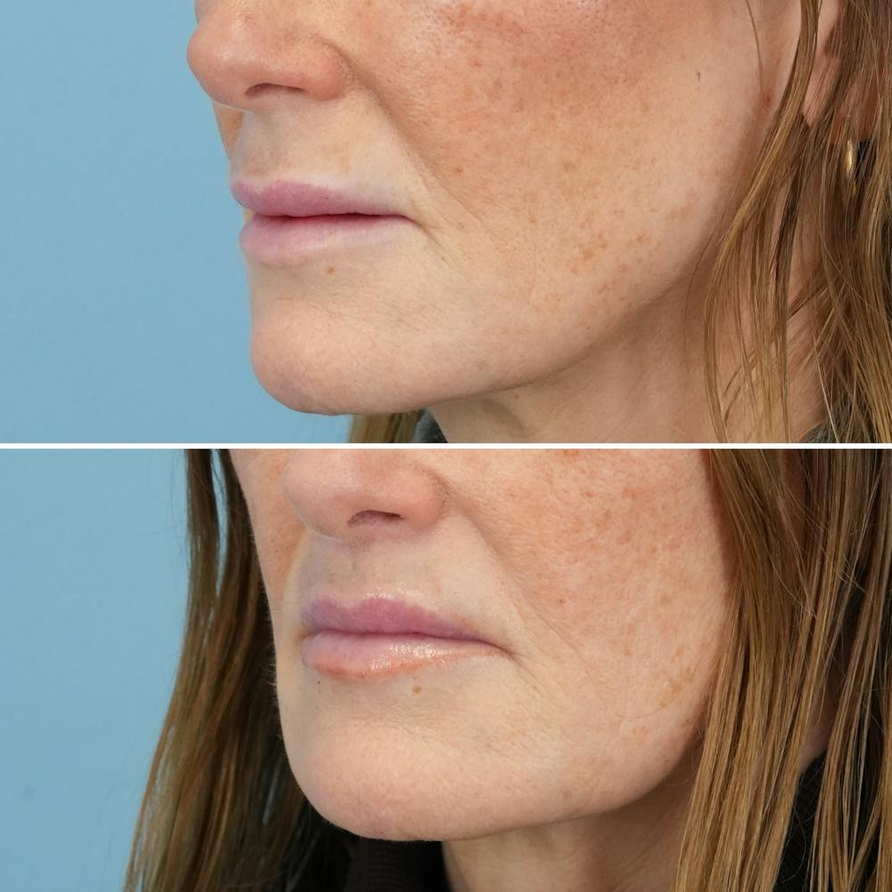 Lip Lift Before & After Gallery - Patient 141568 - Image 7
