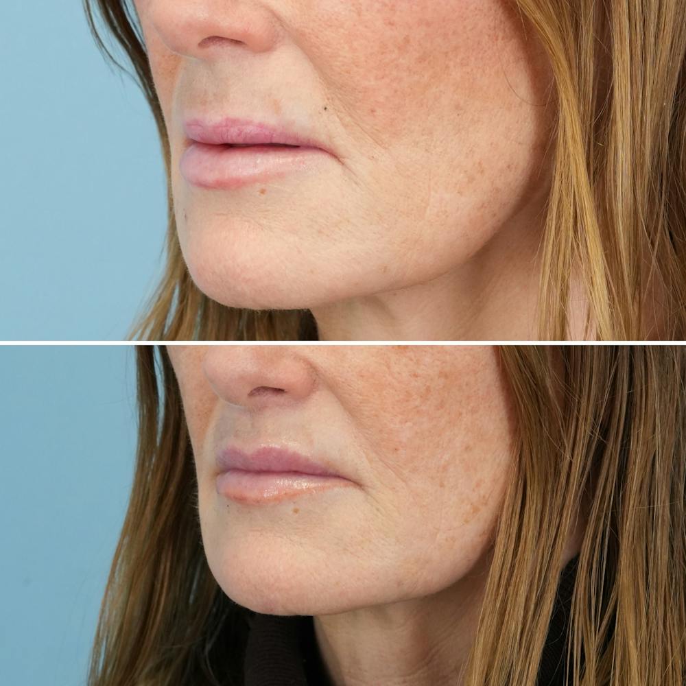 Lip Lift Before & After Gallery - Patient 141568 - Image 6