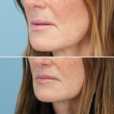 Lip Lift Before & After Gallery - Patient 141568 - Image 6