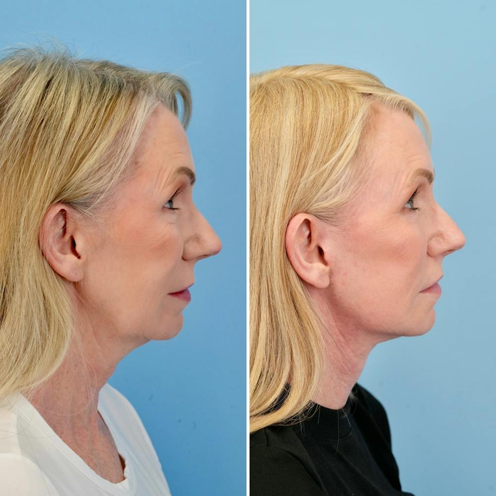 Lip Lift Before & After Gallery - Patient 163232 - Image 3