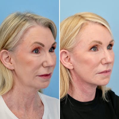 Lip Lift Before & After Gallery - Patient 163232 - Image 2