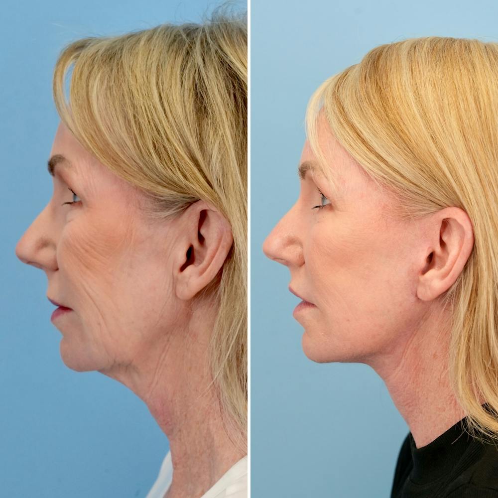 Lip Lift Before & After Gallery - Patient 163232 - Image 5