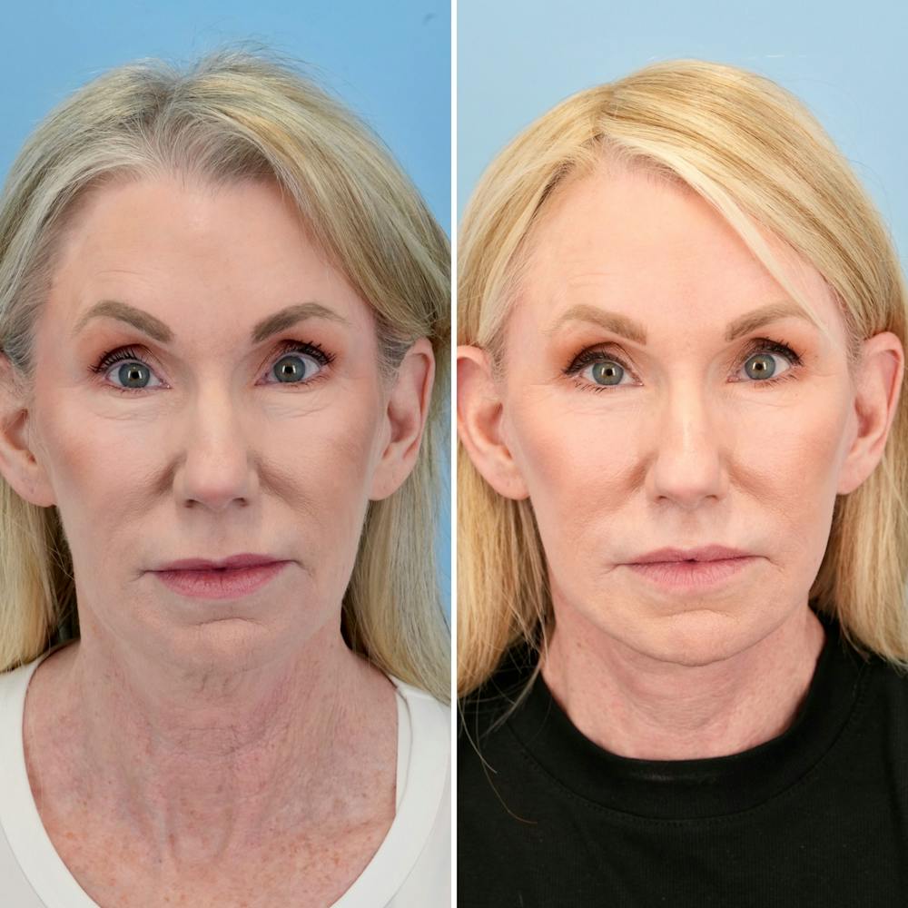 Lip Lift Before & After Gallery - Patient 163232 - Image 1