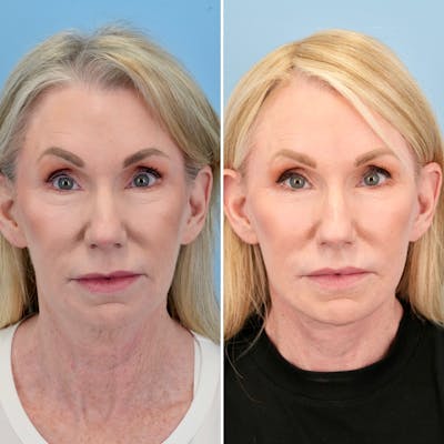 Facelift Before & After Gallery - Patient 541015 - Image 1