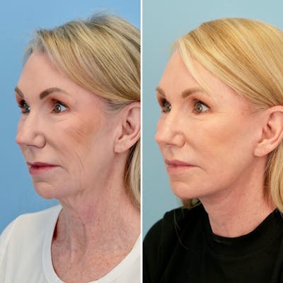 Lip Lift Before & After Gallery - Patient 163232 - Image 4