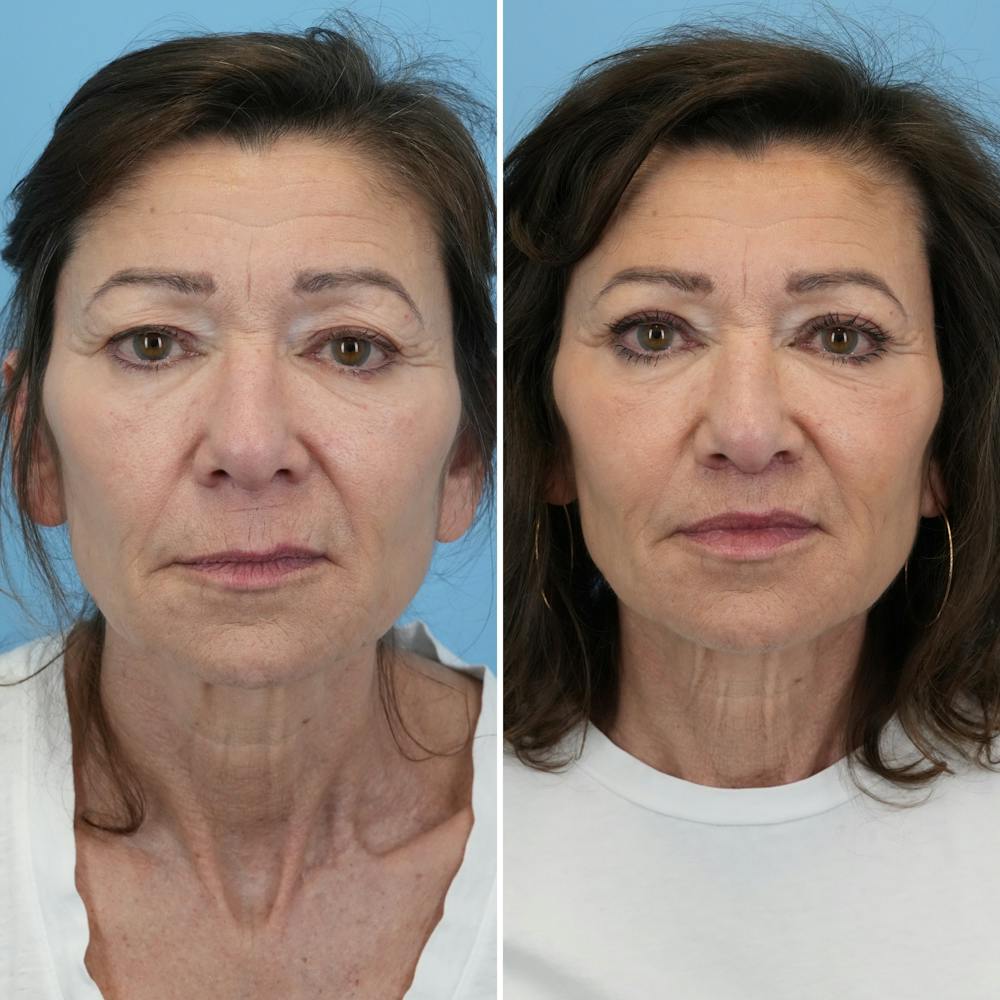 Lip Lift Before & After Gallery - Patient 427389 - Image 1