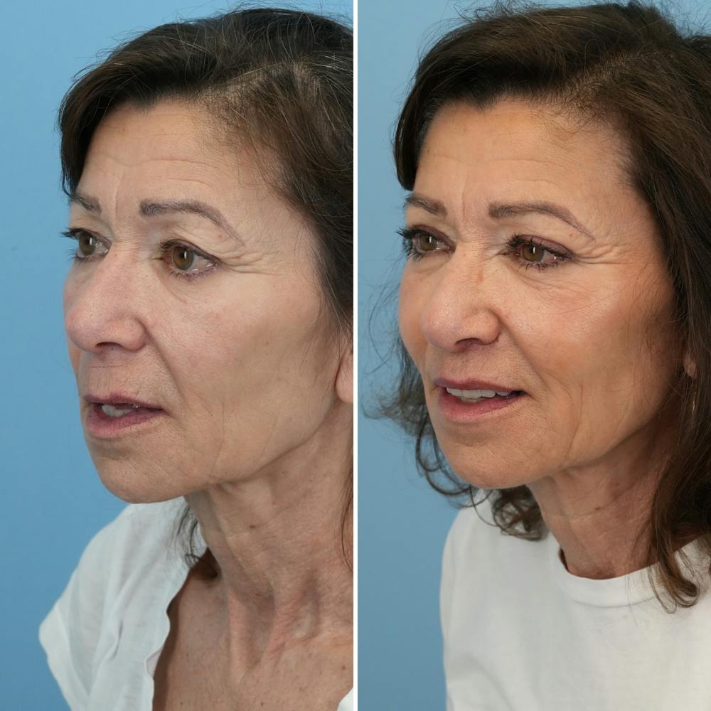 Lip Lift Before & After Gallery - Patient 427389 - Image 6
