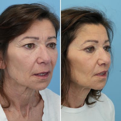 Lip Lift Before & After Gallery - Patient 427389 - Image 4