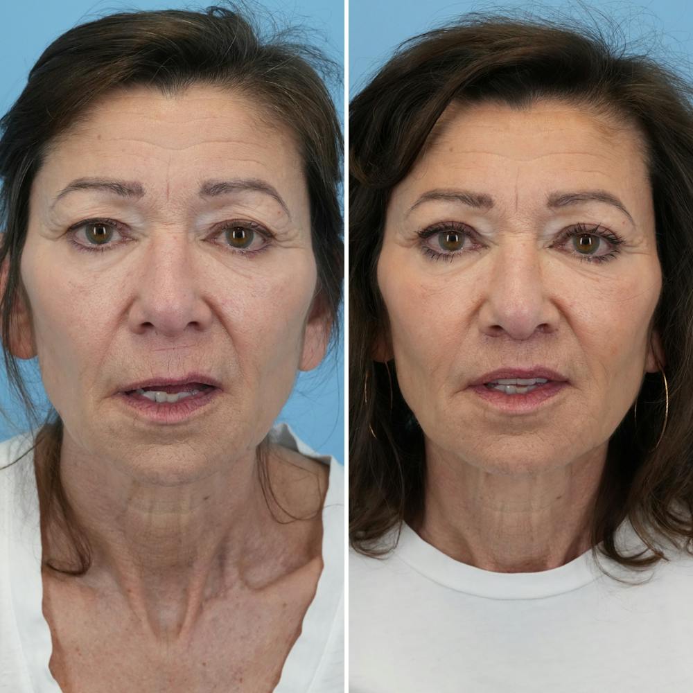 Lip Lift Before & After Gallery - Patient 427389 - Image 2