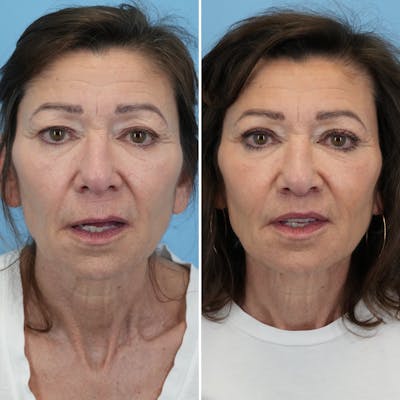 Lip Lift Before & After Gallery - Patient 427389 - Image 2