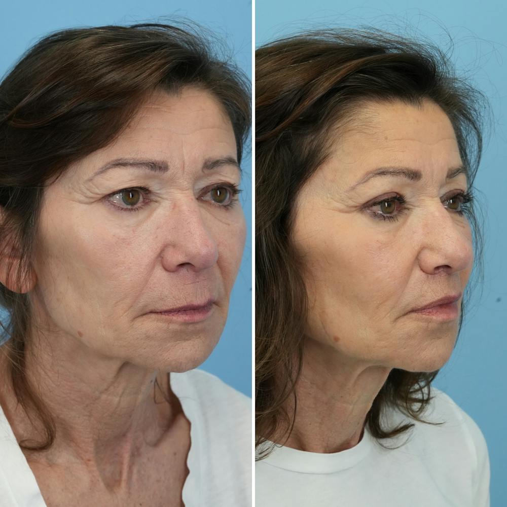 Lip Lift Before & After Gallery - Patient 427389 - Image 3