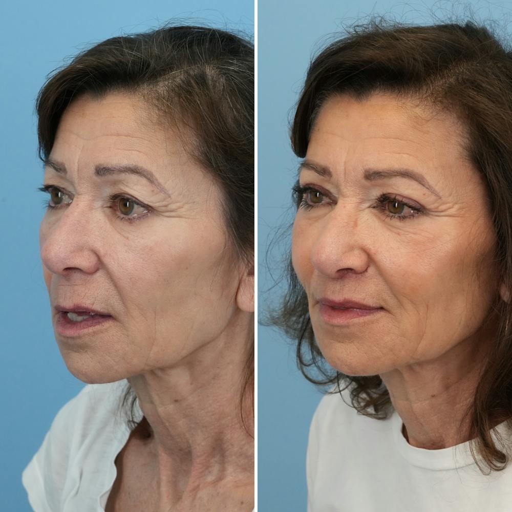 Lip Lift Before & After Gallery - Patient 427389 - Image 5