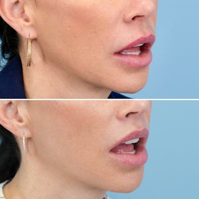 Lip Lift Before & After Gallery - Patient 286163 - Image 4