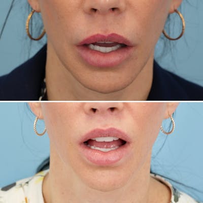 Lip Lift Before & After Gallery - Patient 286163 - Image 2
