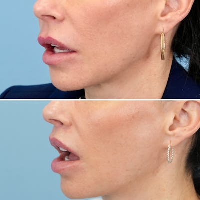 Lip Lift Before & After Gallery - Patient 286163 - Image 6