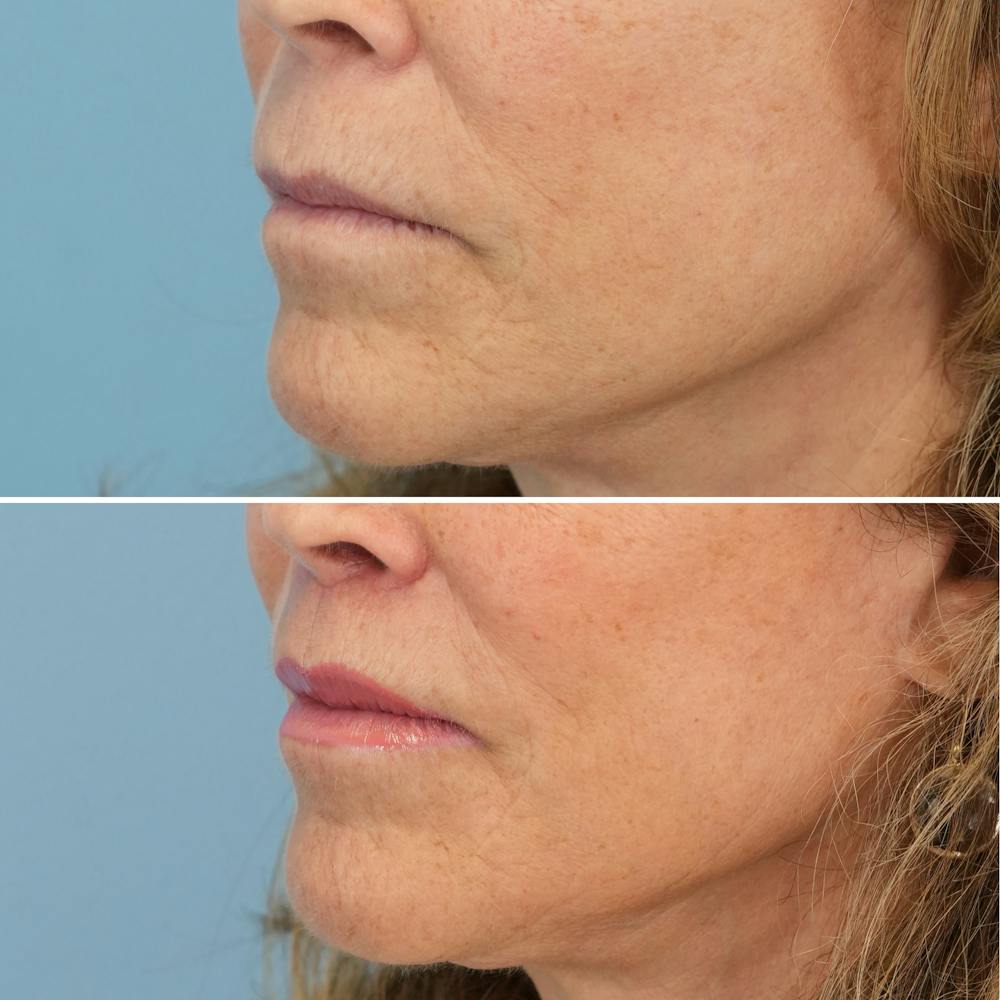 Lip Lift Before & After Gallery - Patient 192914 - Image 3