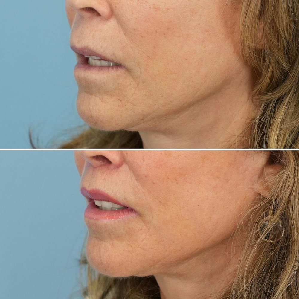 Lip Lift Before & After Gallery - Patient 192914 - Image 4