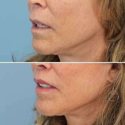 Lip Lift Before & After Gallery - Patient 192914 - Image 4