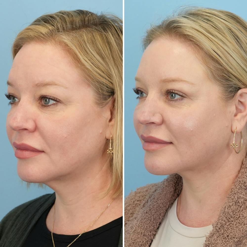 Facelift Before & After Gallery - Patient 123057 - Image 4