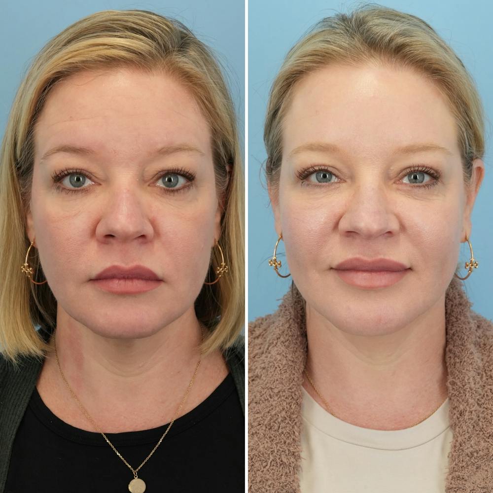 Facelift Before & After Gallery - Patient 123057 - Image 1