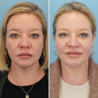 Facelift Before & After Gallery - Patient 123057 - Image 1