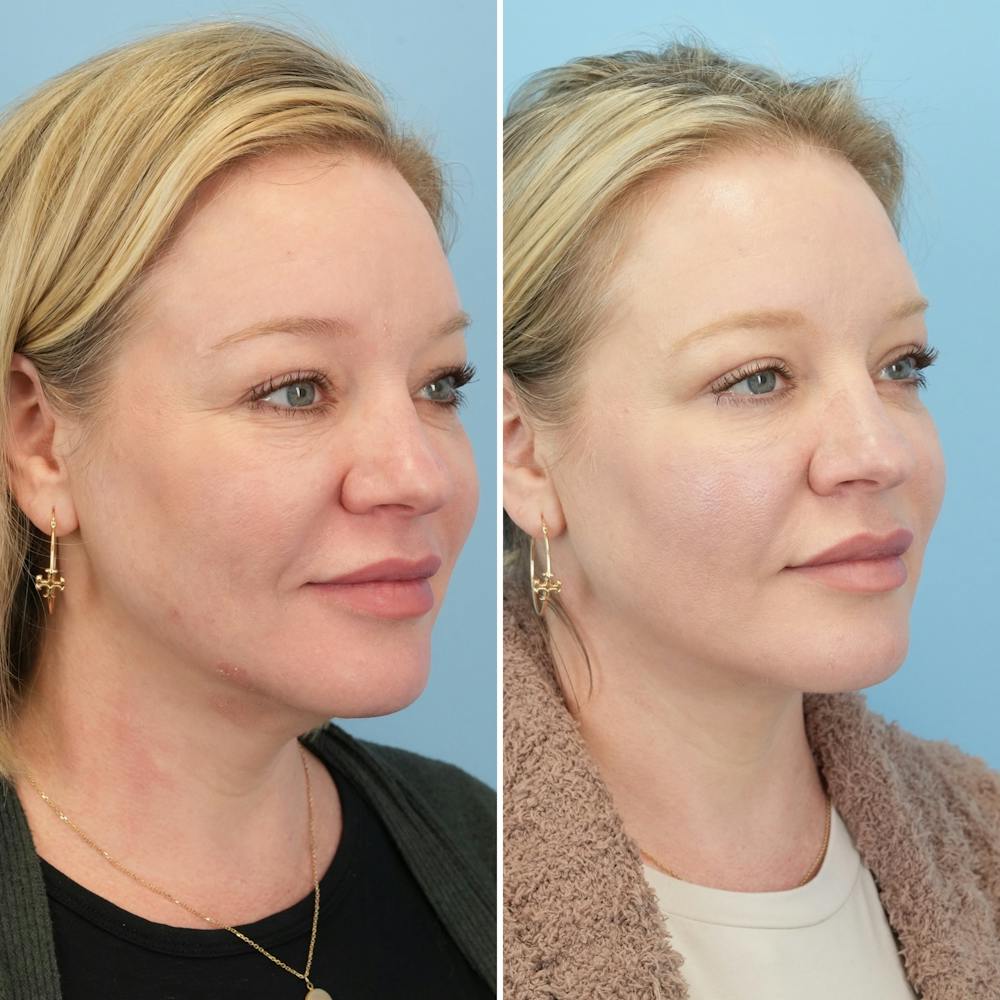 Facelift Before & After Gallery - Patient 123057 - Image 2