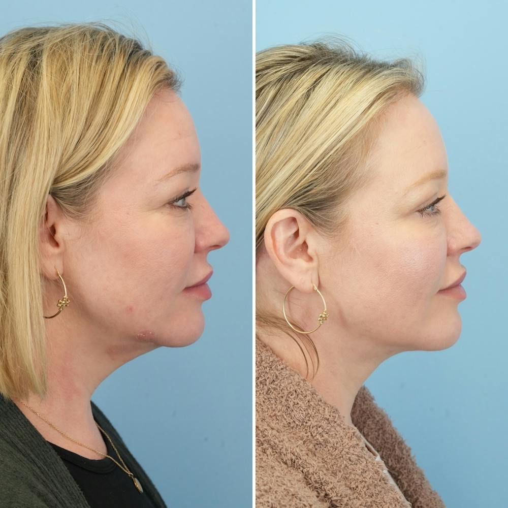Facelift Before & After Gallery - Patient 123057 - Image 3