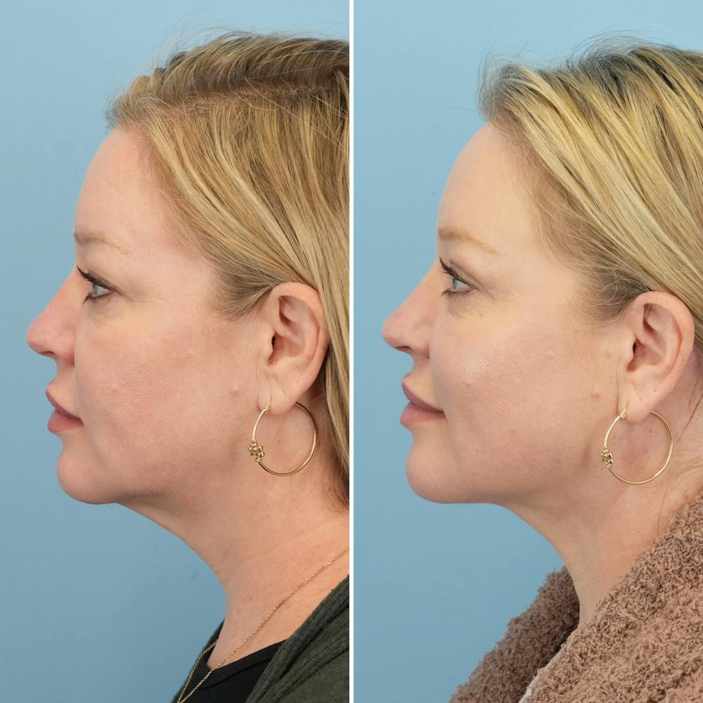 Facelift Before & After Gallery - Patient 123057 - Image 5