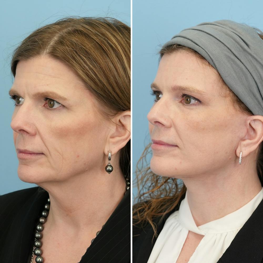Facelift Before & After Gallery - Patient 182809 - Image 4