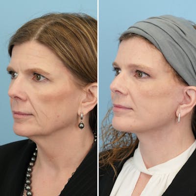 Facelift Before & After Gallery - Patient 182809 - Image 4