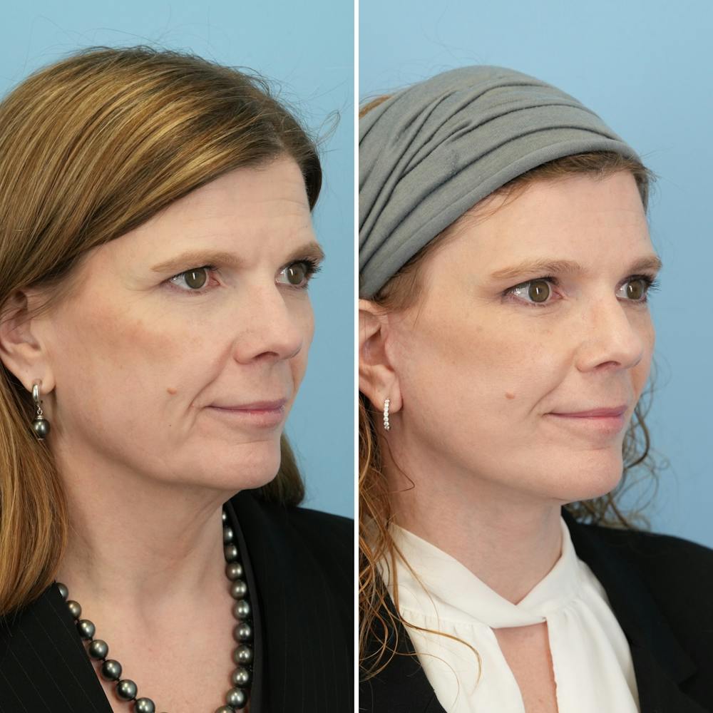Facelift Before & After Gallery - Patient 182809 - Image 2