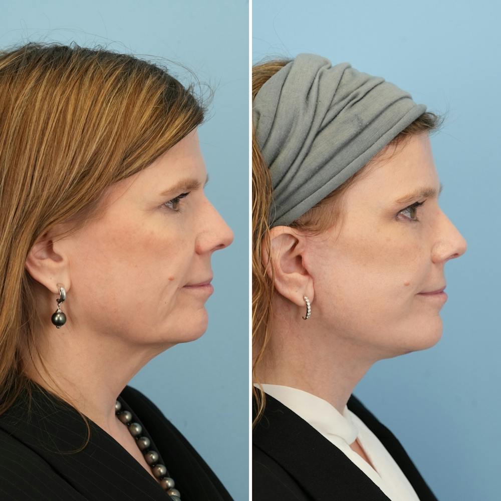 Facelift Before & After Gallery - Patient 182809 - Image 3