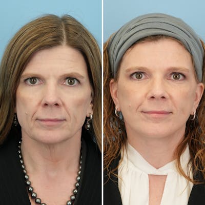 Facelift Before & After Gallery - Patient 182809 - Image 1