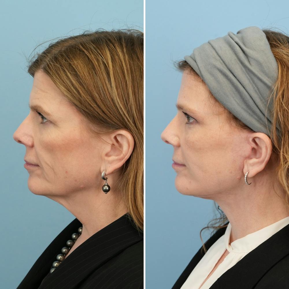Facelift Before & After Gallery - Patient 182809 - Image 5