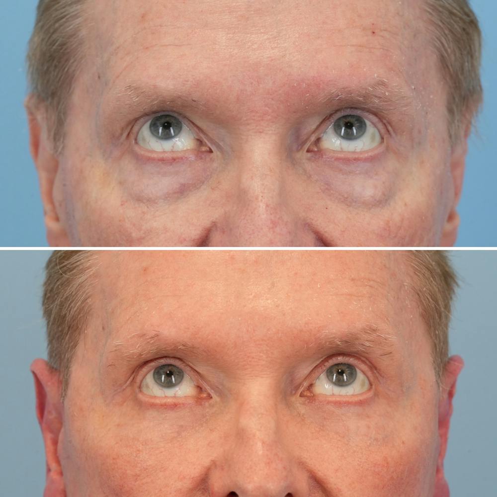 Facelift Before & After Gallery - Patient 161803 - Image 4