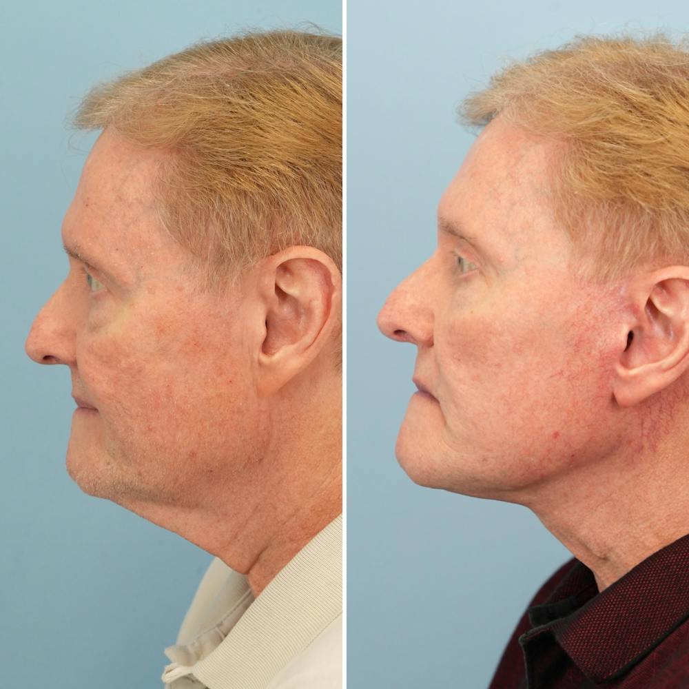 Facelift Before & After Gallery - Patient 161803 - Image 3