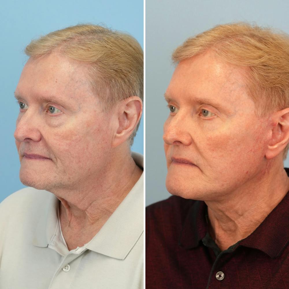 Facelift Before & After Gallery - Patient 161803 - Image 1