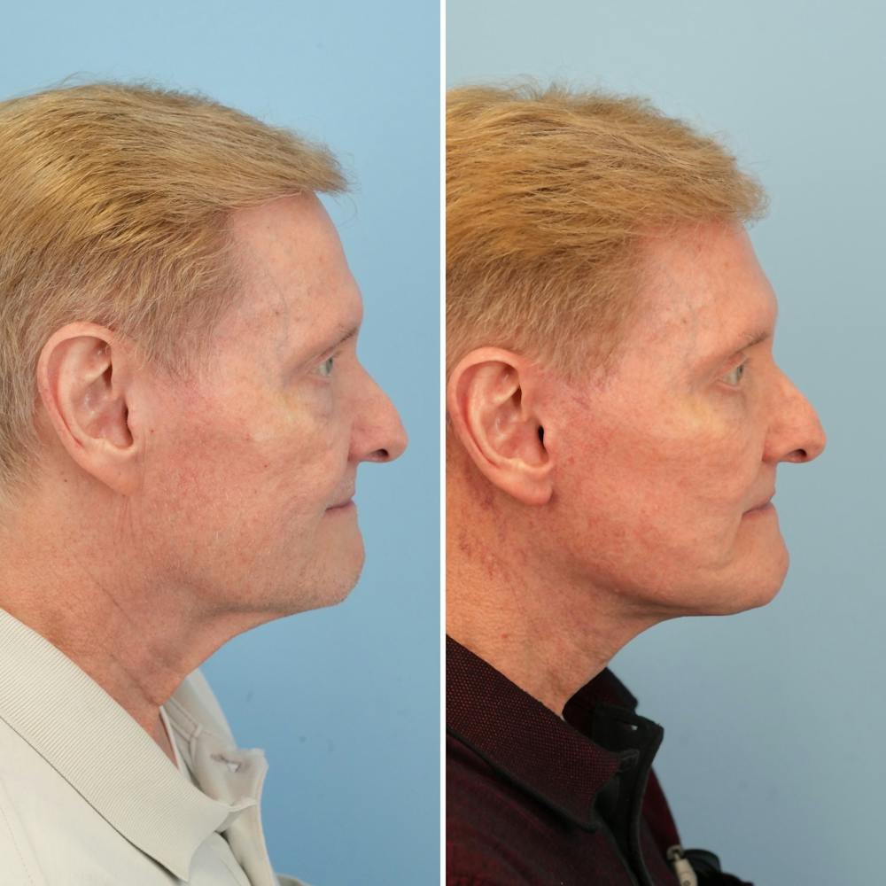 Facelift Before & After Gallery - Patient 161803 - Image 2