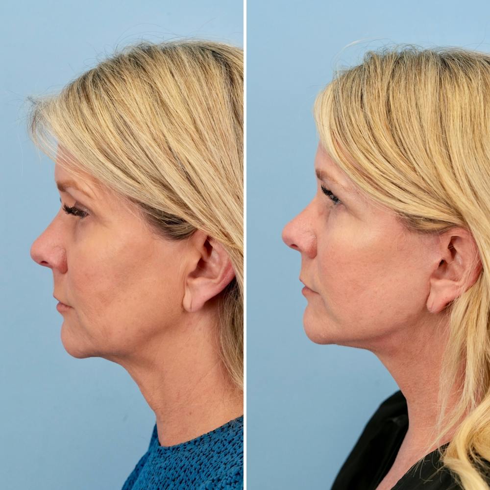 Facelift Before & After Gallery - Patient 372355 - Image 5