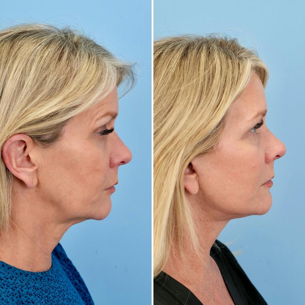 Facelift Before & After Gallery - Patient 372355 - Image 3