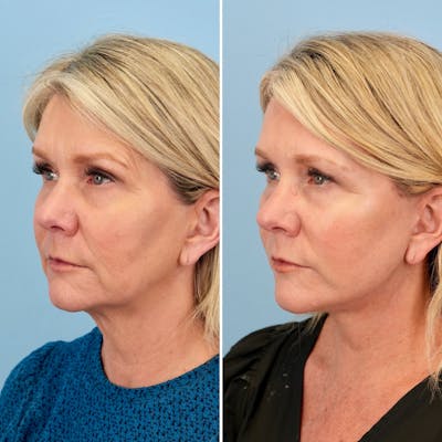 Facelift Before & After Gallery - Patient 372355 - Image 4