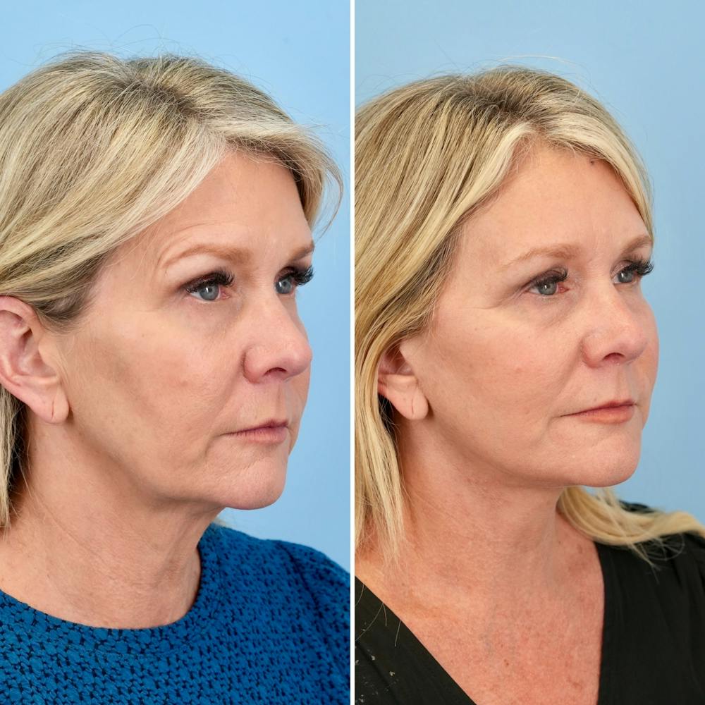 Facelift Before & After Gallery - Patient 372355 - Image 2