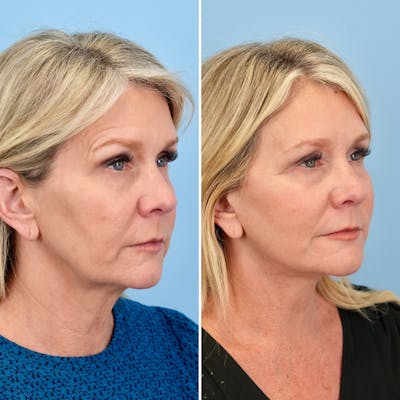 Facelift Before & After Gallery - Patient 372355 - Image 2