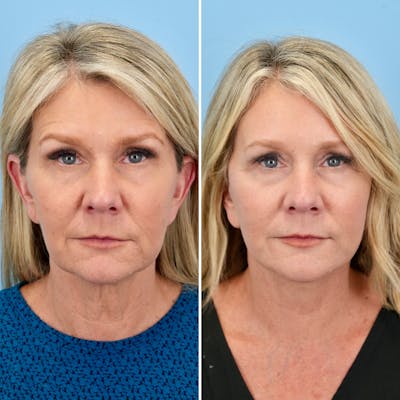 Facelift Before & After Gallery - Patient 372355 - Image 1
