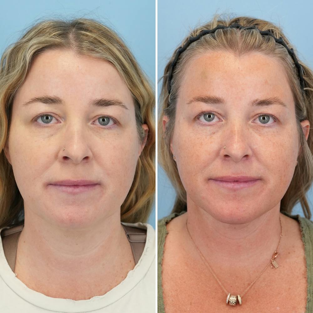 Facelift Before & After Gallery - Patient 247352 - Image 1